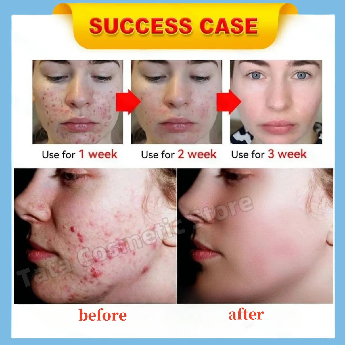 Anti-Acne Gel Acne Treatment Face Cream Repair Pimple