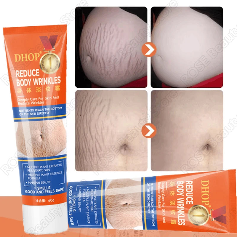 Stretch Marks Permanent Removal Cream Maternity Pregnant
