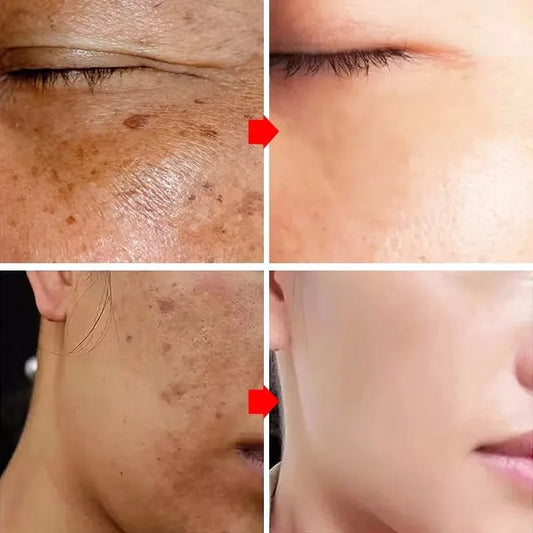 Dark Spots Remover Whitening Serum Face Freckle Melanin
