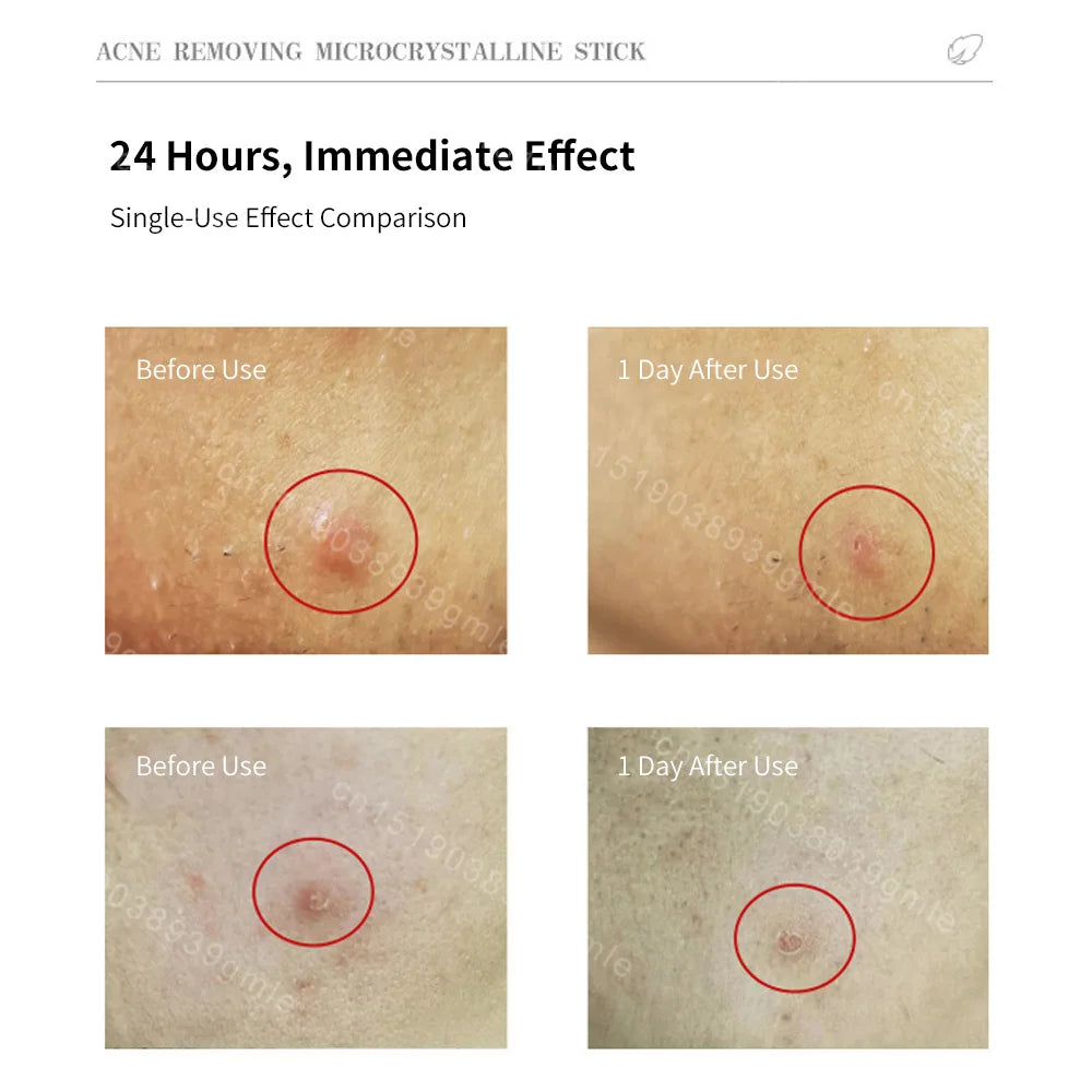 Microneedles Acne Patch Invisible Breathable Skin Care