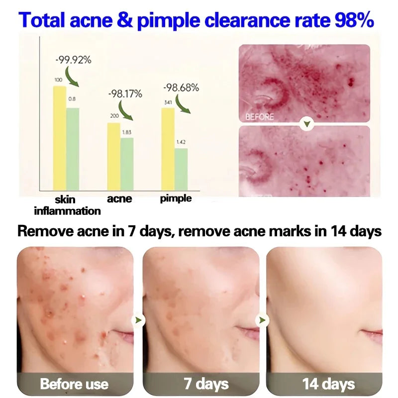 Anti-Acne Gel Acne Treatment Face Cream Repair Pimple