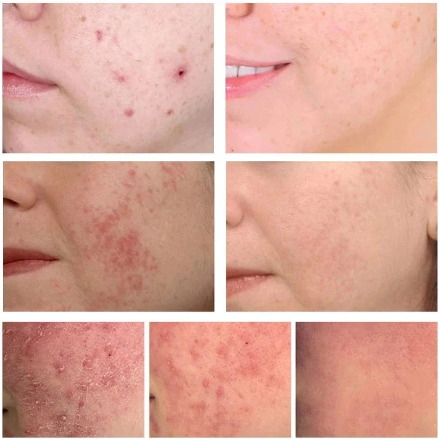 Anti-Acne Gel Acne Treatment Face Cream Repair Pimple