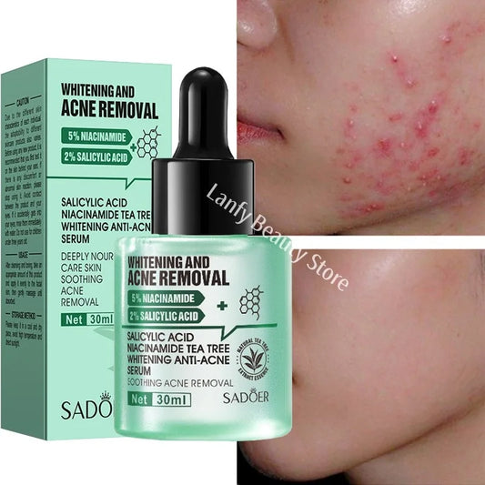 Acne Removal Whitening Serum Effective Fade Acne Spots