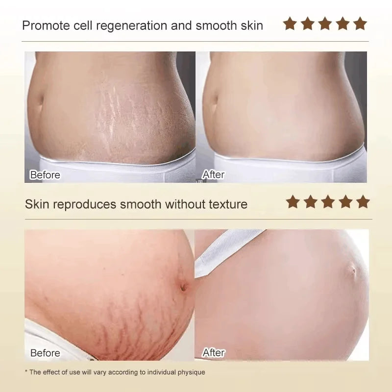 Stretch Marks Permanent Removal Cream Maternity Pregnant