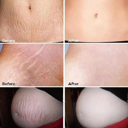 Stretch Marks Permanent Removal Cream Maternity Pregnant