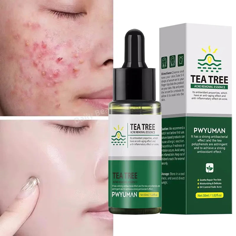 Acne Removal Whitening Serum Effective Fade Acne Spots