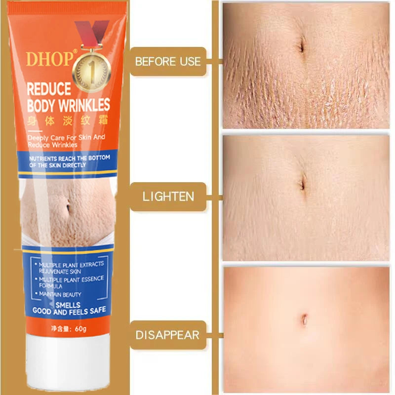 Stretch Marks Permanent Removal Cream Maternity Pregnant