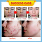 Anti-Acne Gel Acne Treatment Face Cream Repair Pimple