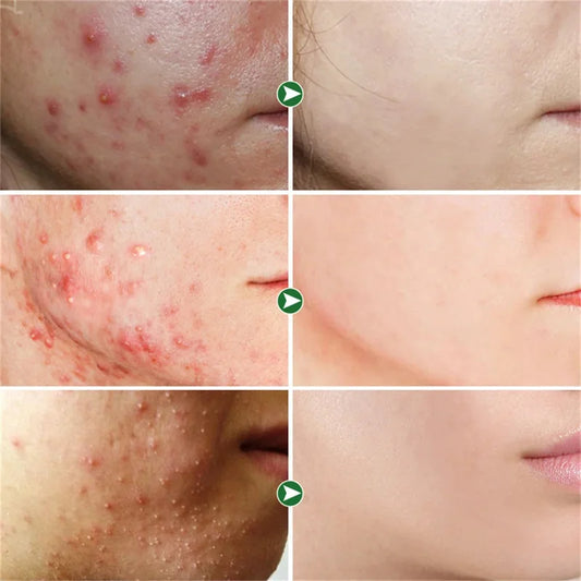 Acne Removal Whitening Serum Effective Fade Acne Spots