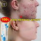 Anti-Acne Gel Acne Treatment Face Cream Repair Pimple