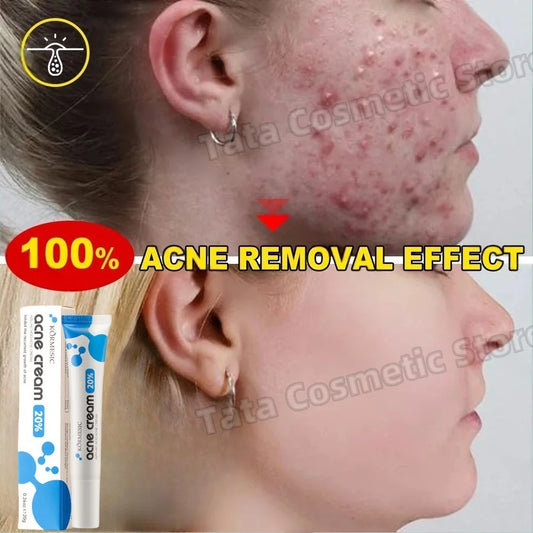Anti-Acne Gel Acne Treatment Face Cream Repair Pimple