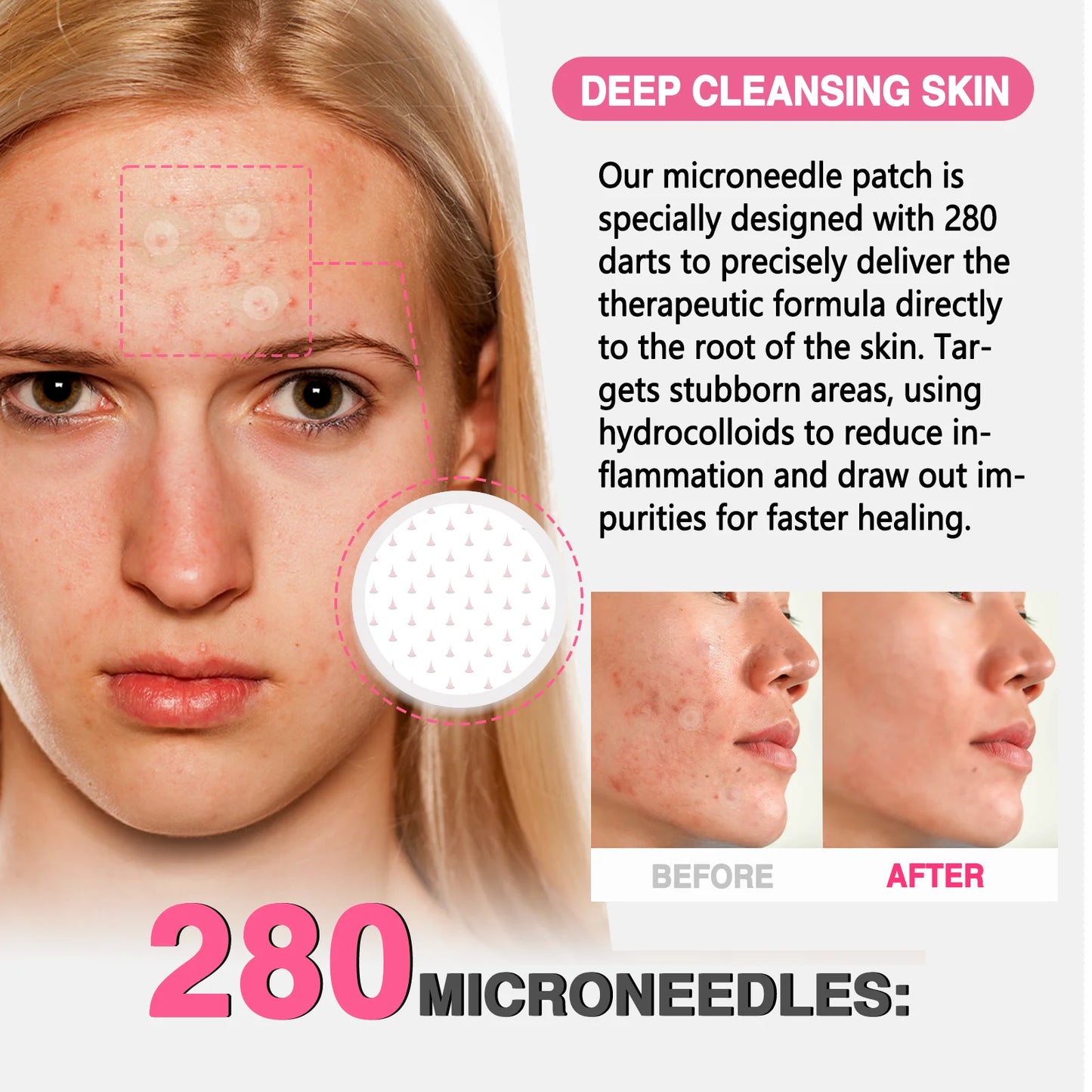 GROEI 18Pcs Microneedle Acne Patches Pimple Invisible Beauty