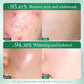 Acne Removal Whitening Serum Effective Fade Acne Spots
