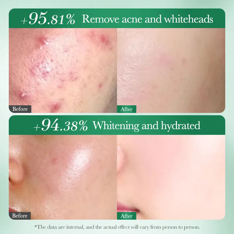 Acne Removal Whitening Serum Effective Fade Acne Spots