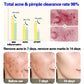 Anti-Acne Gel Acne Treatment Face Cream Repair Pimple