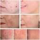 Anti-Acne Gel Acne Treatment Face Cream Repair Pimple
