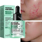 Acne Removal Whitening Serum Effective Fade Acne Spots
