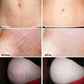 Stretch Marks Permanent Removal Cream Maternity Pregnant