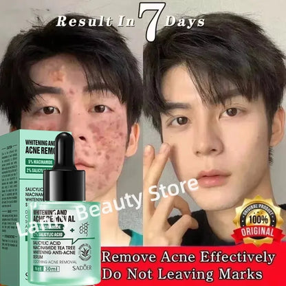 Acne Removal Whitening Serum Effective Fade Acne Spots